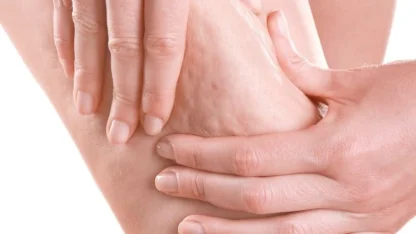 Prof. Dr. Karacalar’dan selülit uyarısı: Portakal kabuğu görüntüsü basit sorun değil!